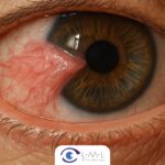 Pterigion o Carnosidad: Causas, síntomas y tratamiento