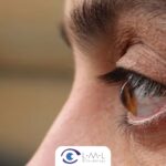 ¿Qué es el queratocono? Causas, Síntomas, Tratamientos