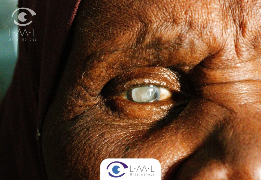 Cataratas en los ojos: Síntomas, diagnóstico y tratamiento