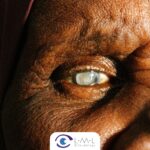 Cataratas en los ojos: Síntomas, diagnóstico y tratamiento