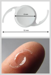 Tamaño de los lentes intraoculares