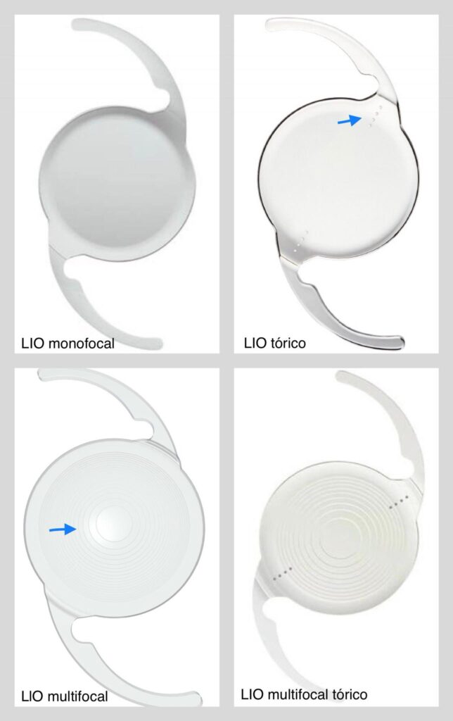 Tipos de lentes intraoculares